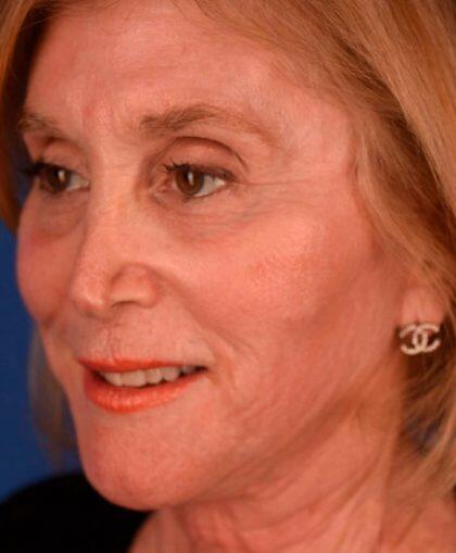 Facelift Before & After Image