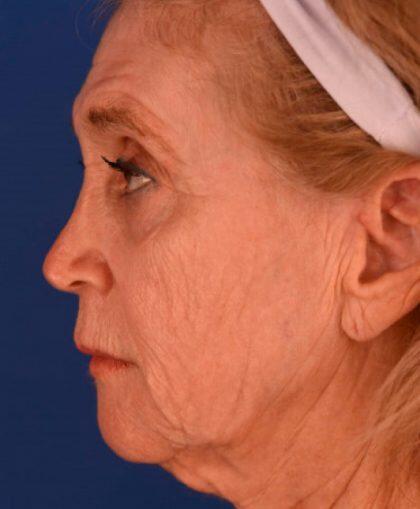 Facelift Before & After Image