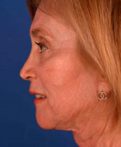Facelift Before & After Image