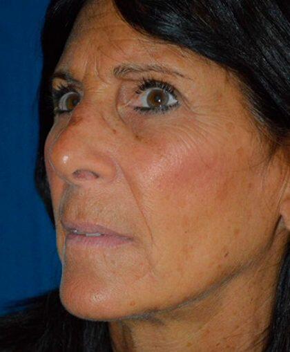 Facelift Before & After Image