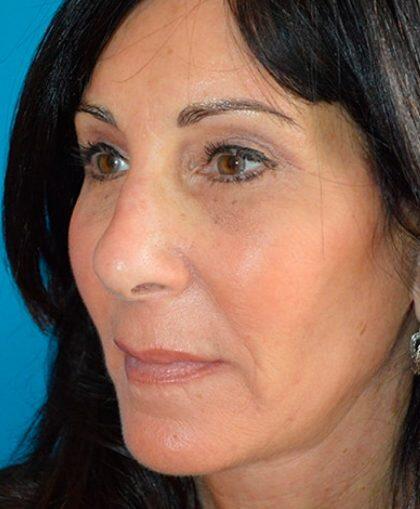 Facelift Before & After Image