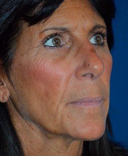 Facelift Before & After Image