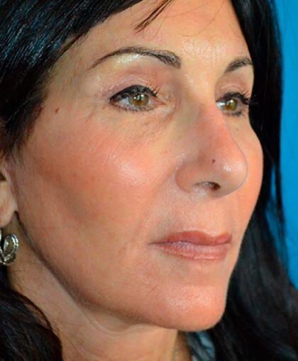 Facelift Before & After Image