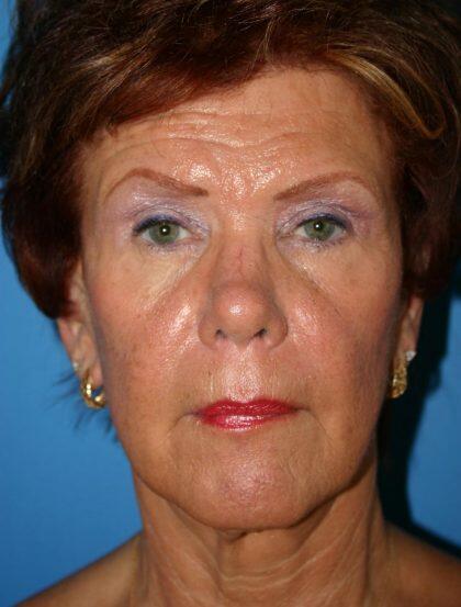 Facelift Before & After Image