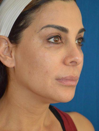 Facelift Before & After Image