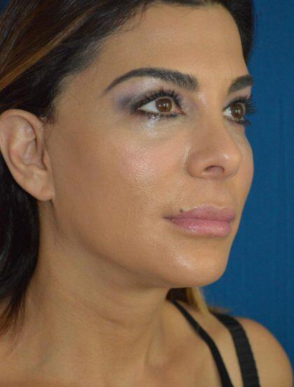 Facelift Before & After Image