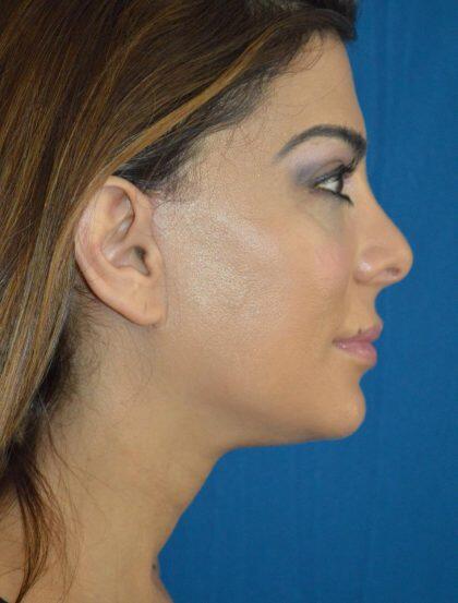 Facelift Before & After Image