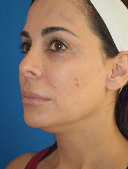Facelift Before & After Image
