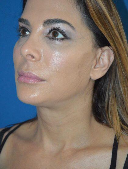 Facelift Before & After Image