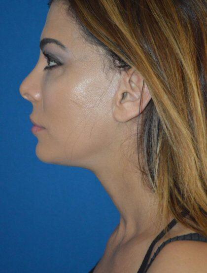 Facelift Before & After Image