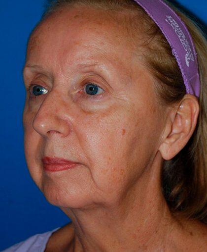 Facelift Before & After Image
