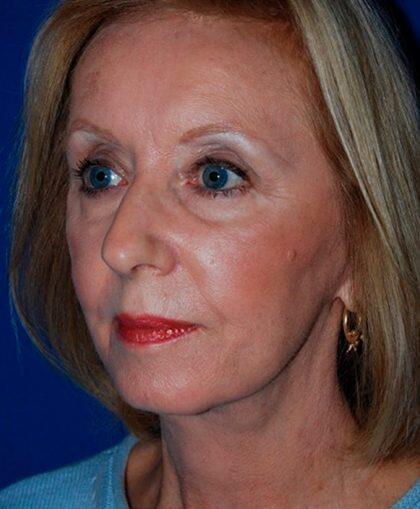 Facelift Before & After Image