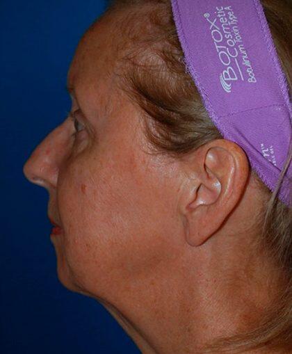 Facelift Before & After Image