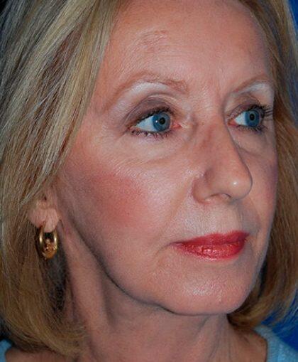 Facelift Before & After Image