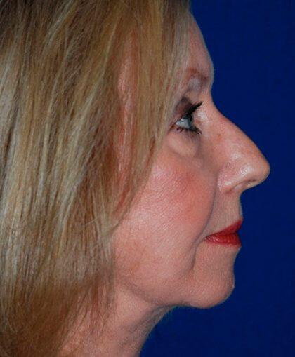 Facelift Before & After Image
