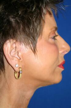 Facelift Before & After Image