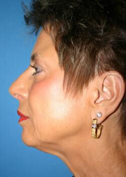 Facelift Before & After Image