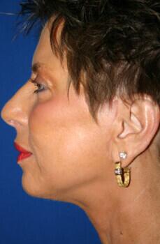 Facelift Before & After Image