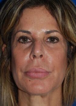 Facelift Before & After Image