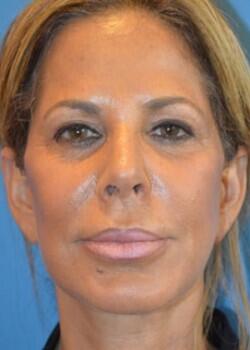 Facelift Before & After Image