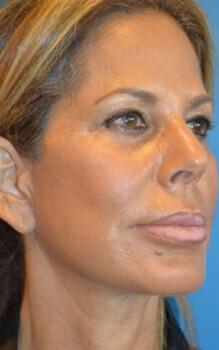 Facelift Before & After Image