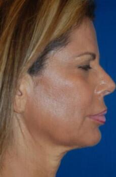 Facelift Before & After Image