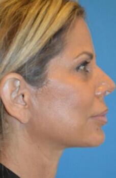 Facelift Before & After Image