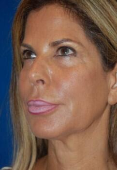 Facelift Before & After Image