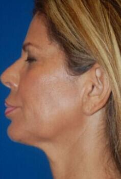 Facelift Before & After Image