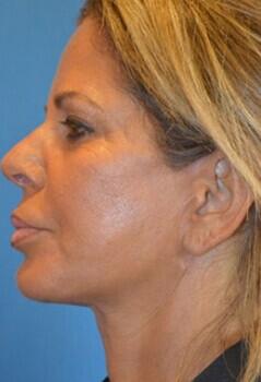 Facelift Before & After Image