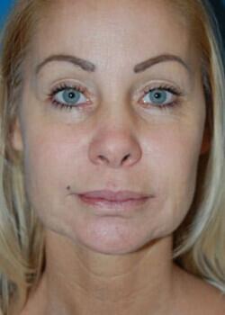 Facelift Before & After Image