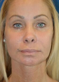 Facelift Before & After Image