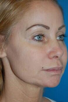 Facelift Before & After Image