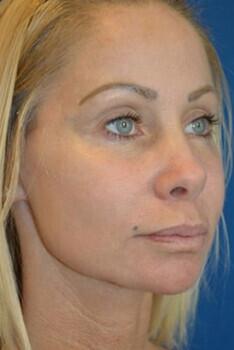 Facelift Before & After Image