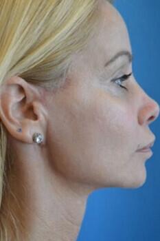 Facelift Before & After Image