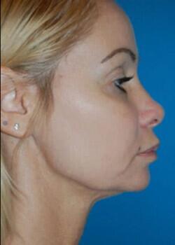 Facelift Before & After Image