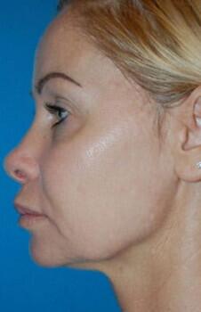 Facelift Before & After Image