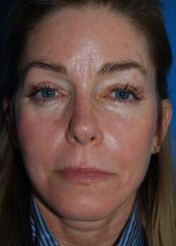 Facelift Before & After Image