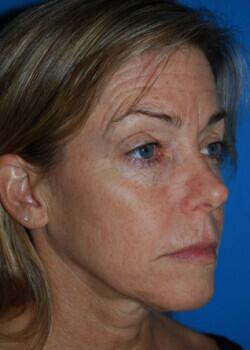 Facelift Before & After Image