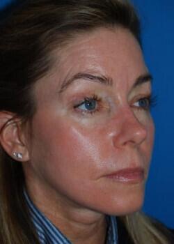 Facelift Before & After Image