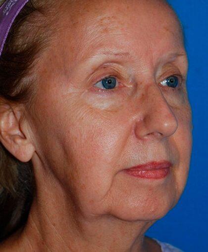 Facelift Before & After Image