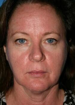 Facelift Before & After Image