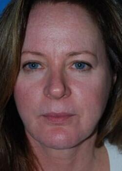 Facelift Before & After Image