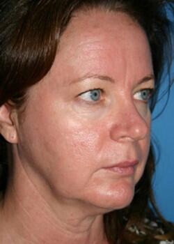 Facelift Before & After Image