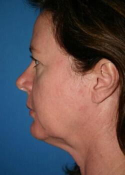 Facelift Before & After Image