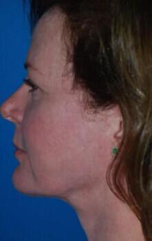 Facelift Before & After Image