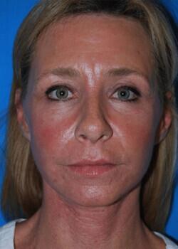 Facelift Before & After Image