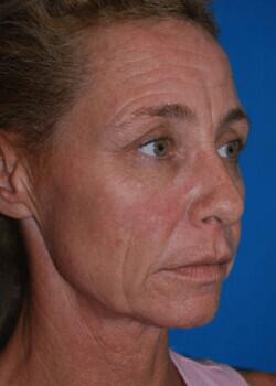 Facelift Before & After Image