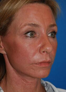 Facelift Before & After Image