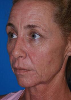 Facelift Before & After Image